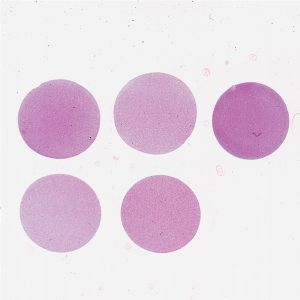 Skin Cancer Cell Pellet Array